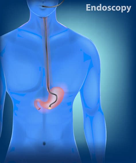 Endoscopy Lab Results at Lakisha Harmon blog