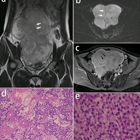 CT And MRI Features Of The 13 Ovarian Dysgerminomas In 12 Patients