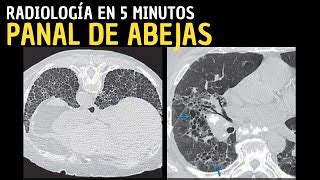 Radiolog A En Minutos Signos Radiol Gicos Pulmonares Doovi