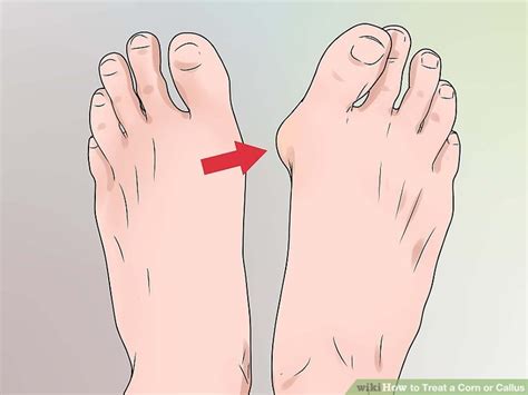 How to Treat a Corn or Callus (with Pictures) - wikiHow