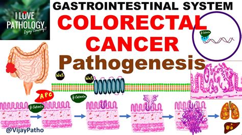 Colorectal Carcinoma Epidemiology Risk Factors And Pathogenesis Youtube