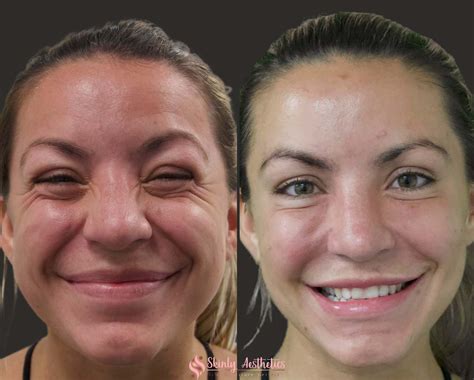 Botox Before And After Results Everything You Need To See And Know