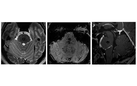 Cavernous Malformations 7T MRI Enhances Expertise Mayo Clinic