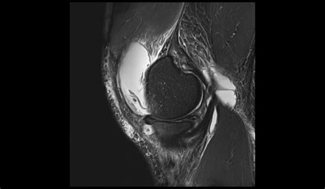 Baker's cyst rupture MRI | Radiology Article on Baker cyst rupture