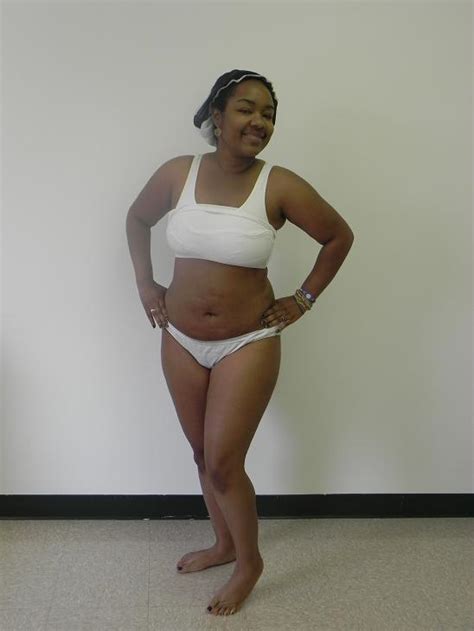 My Laser Lipo Journey American Lipo Centers Weeks After Laser Lipo