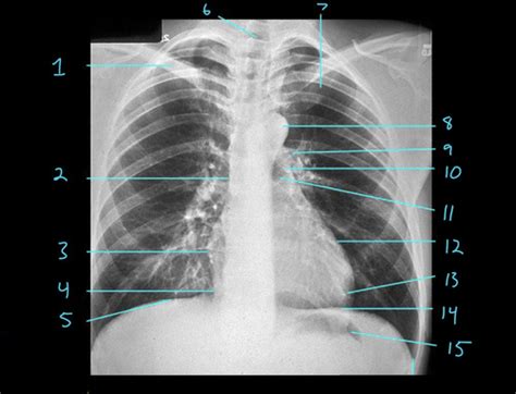 MODULE 2 RADIOGRAPHS Flashcards Quizlet