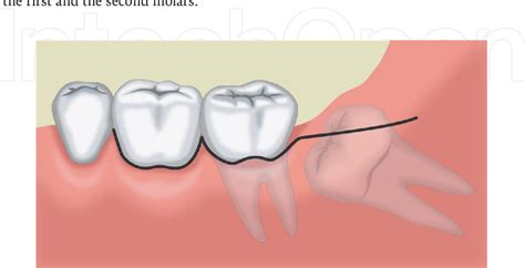 Figure From Flap Techniques In Dentoalveolar Surgery Semantic Scholar