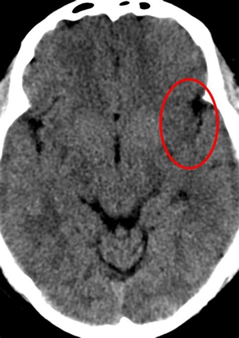 Axial Noncontrast Ct Image Of Brain Shows Loss Of Definition Of The