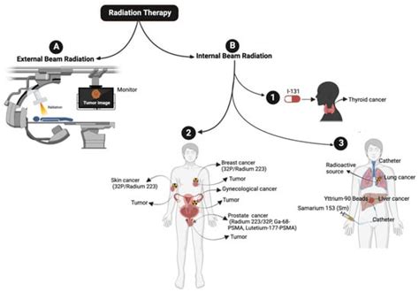 Radiation Therapy Diagram