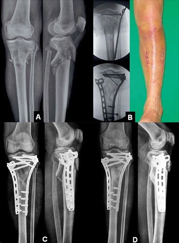 Full Article Double Plating Of Unstable Proximal Tibial Fractures