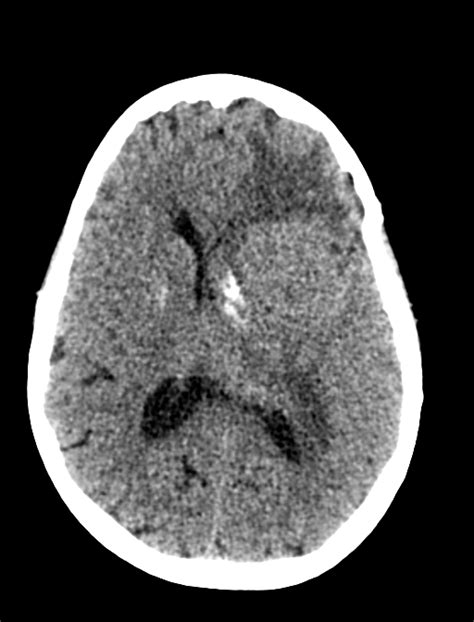 Multiple Chordoid Meningiomas Post Radiotherapy Image Radiopaedia Org