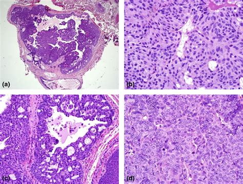 Wt Expression In Endocrine Mucinproducing Sweat Gland Carcinoma A