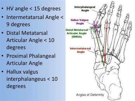 Hallux Valgus Telegraph