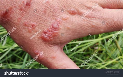 Cow Parsnip Burns Treatment