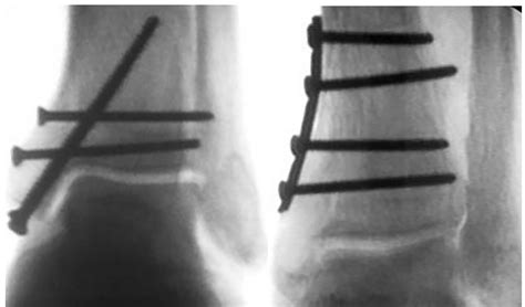 Supination Adduction Vertical Medial Malleolar Fracture Fixation With Buttress Plating Vs A