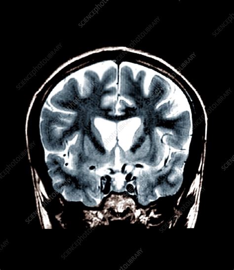 Brain in Huntington's disease, MRI - Stock Image - C023/9794 - Science ...