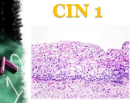 Cervical Intraepithelial Neoplasia Ppt