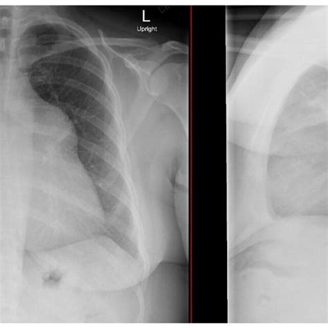 Chest X Ray Demonstrating Enlarged Cardiac Silhouette With Mediastinal