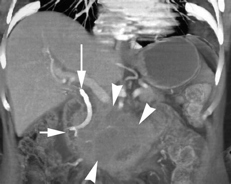 Peripancreatic Masses That Simulate Pancreatic Disease Spectrum Of