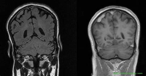 Dr Balaji Anvekar Frcr Ectatic Cortical Vein