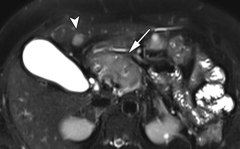 Pancreatic Neuroendocrine Neoplasms 2020 Update On Pathologic And