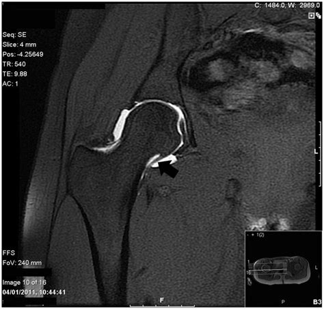 Mr Arthrogram T2 Weighted Fat Suppressed Sequence Of A Right Hip In Download Scientific