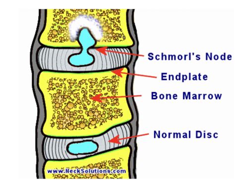 Figure Schmorl Node Illustration Courtesy Of Statpearls Ncbi