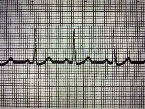 Ekg Flashcards Quizlet