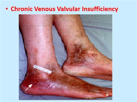 Peripheral Vascular System Health Assessment Flashcards Quizlet