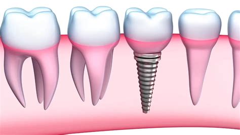 Simple Reasons Why Dental Implants Are Important Better Life Day