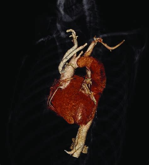 Computed Tomography Aortogram Reconstructed Image Of Aorta Prior To Download Scientific Diagram