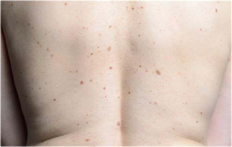 What are Moles (Symptoms & Causes) - A Detailed Study on Skin Moles