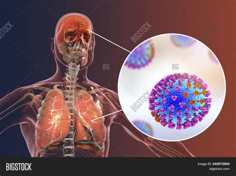 Influenza Image & Photo (Free Trial) | Bigstock