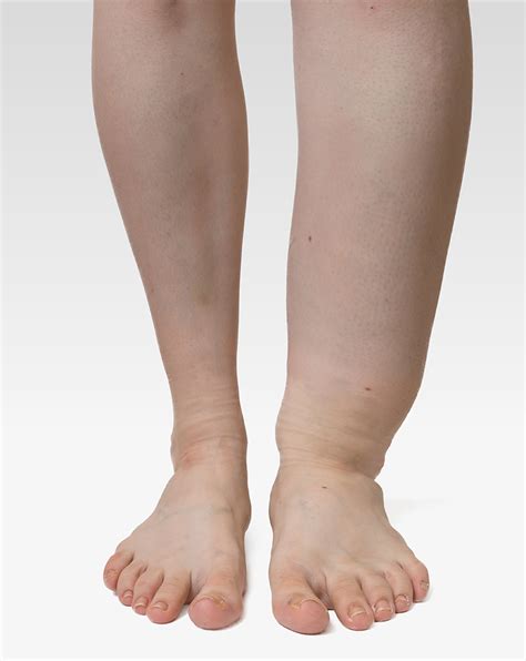 Swelling In Legs And Thighs At Terry Comer Blog