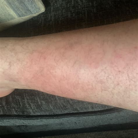 Migraines give my partner a scald on his leg, has anyone else
