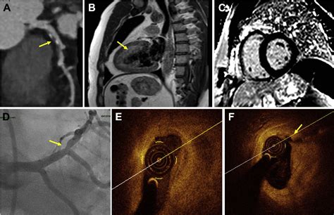 Figure From The Role Of A Multimodality Imaging Approach In Diagnosis