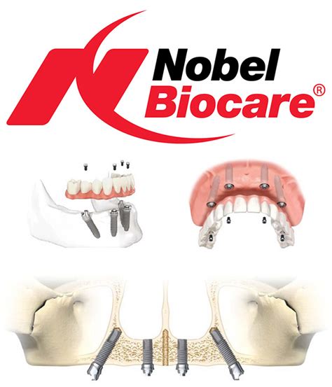 Why We Use Nobel Biocare Dental Implants Tribeca Advanced Dentistry