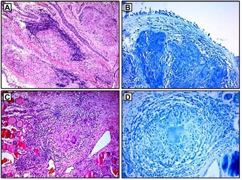 Frontiers Case Report Thyroid Sarcoidosis As A Rare Localization Of