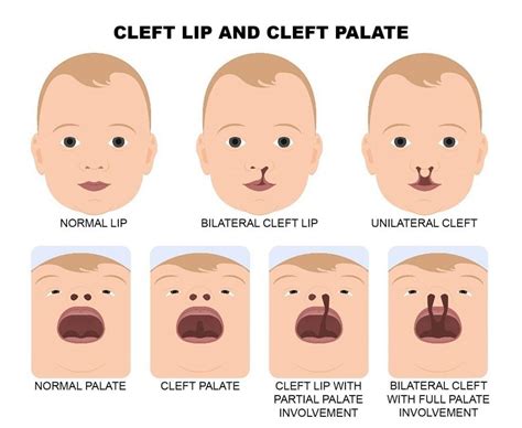 Cleft And Craniofacial Awareness Month