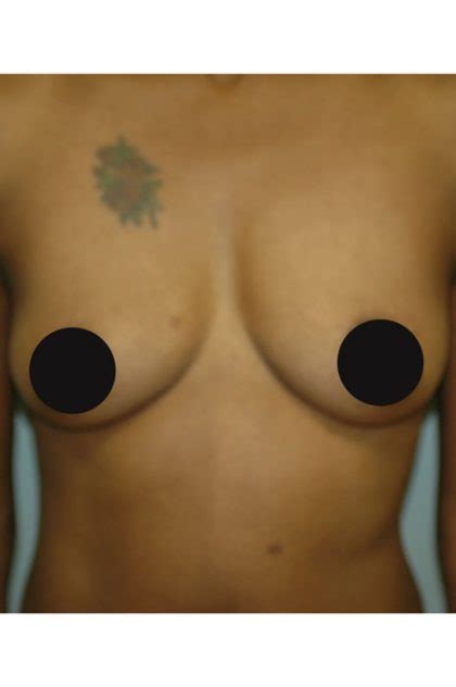 Patient 990 Breast Augmentation Before And After Photos New Jersey