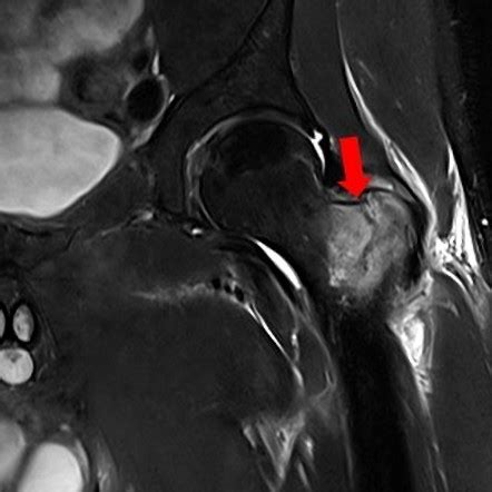 Incomplete Intertrochanteric Fracture Image Radiopaedia Org