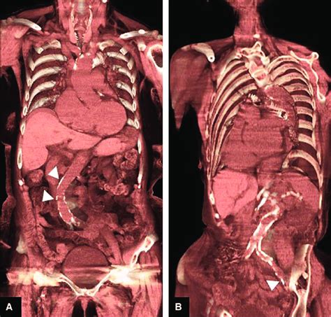 Torsion And Calcification A Arrowhead Of The Abdominal Aorta As