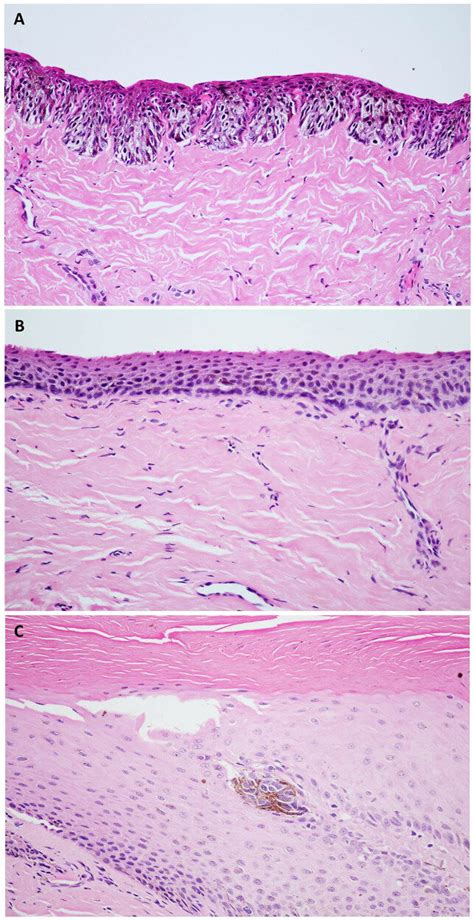 Representative Histopathological Pictures A Atypical Melanocytic