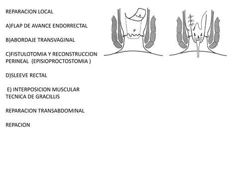 FISTULA RECTO VAGINAL Coloproctologia I PPT