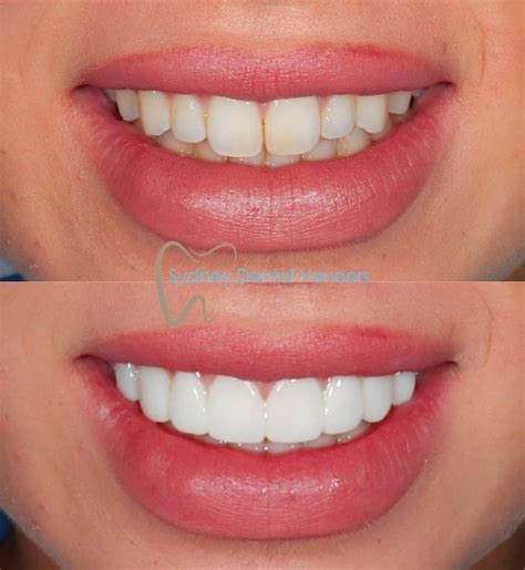 Composite Veneers Cost Sydney Sydney Dental Veneers