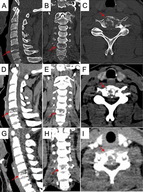 Ct Scan Showing C6 Vertebral Body Collapse And Bone Destruction A To