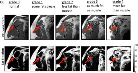 Rotator Cuff Atrophy Mri
