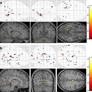 Showing BOLD activation image in left strabismic amblyopia after... | Download Scientific Diagram