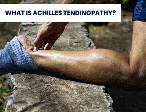 What Is Achilles Tendinopathy Ortho Remedy Clinic