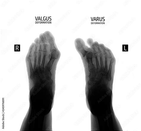 X-ray of the foot. Varus and valgus deformity of the 1st finger ...